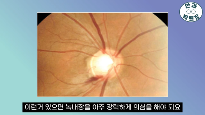 마장동 안과, 야간 저혈압 있다면 정상 안압 녹내장도 확인해야 하는 이유