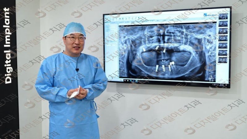 부산임플란트 잘하는곳 상담에서 보철 점검 주기도 물어봐도 될까?