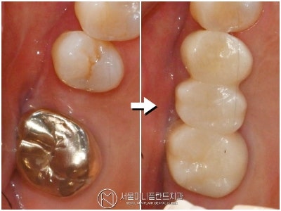 광진구 치과 한번 치료했던 부위 재치료 가능할까? 크라운 교체 브릿지 및 임플란트 보철까....