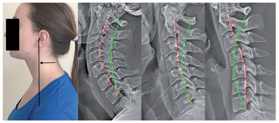목 엑스레이에서 ‘일자목’이라는데, 통증의 원인일까요? 거북목·목디스크·역C자목과 X-ray....