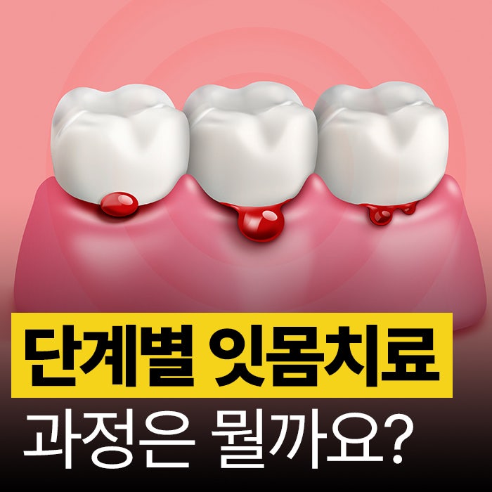 장유치과 단계별 잇몸치료 비용, 치근활택술 치주소파술 뭘까요?