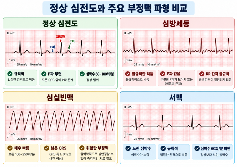 부정맥이란? 심장이 빨리·느리게·불규칙하게 뛰는 이유부터 NYHA 심부전 기능분류까지