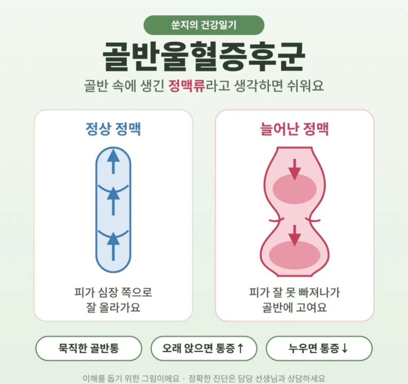 골반울혈증후군 증상 직접 겪어보니-진단,치료 방법 정리