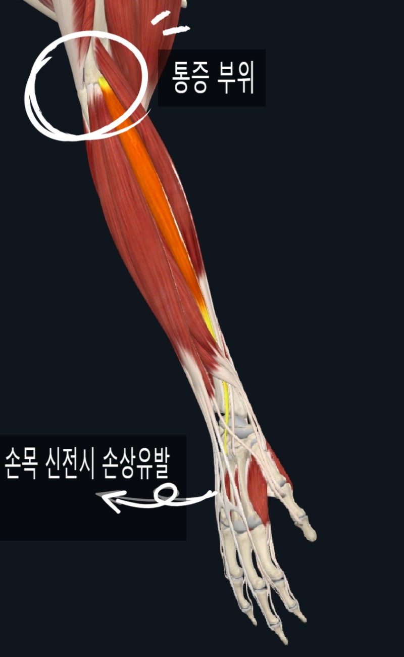 외측상과염 테니스 엘보는 왜 잘 안낫는걸까요 ?