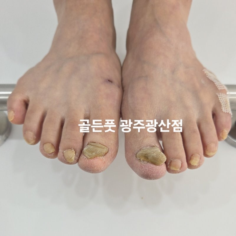 광주 무좀발톱으로 병원을 다녔지만, 효과가 없어 중도포기를 한 상태. 현재는 골든풋 광주....