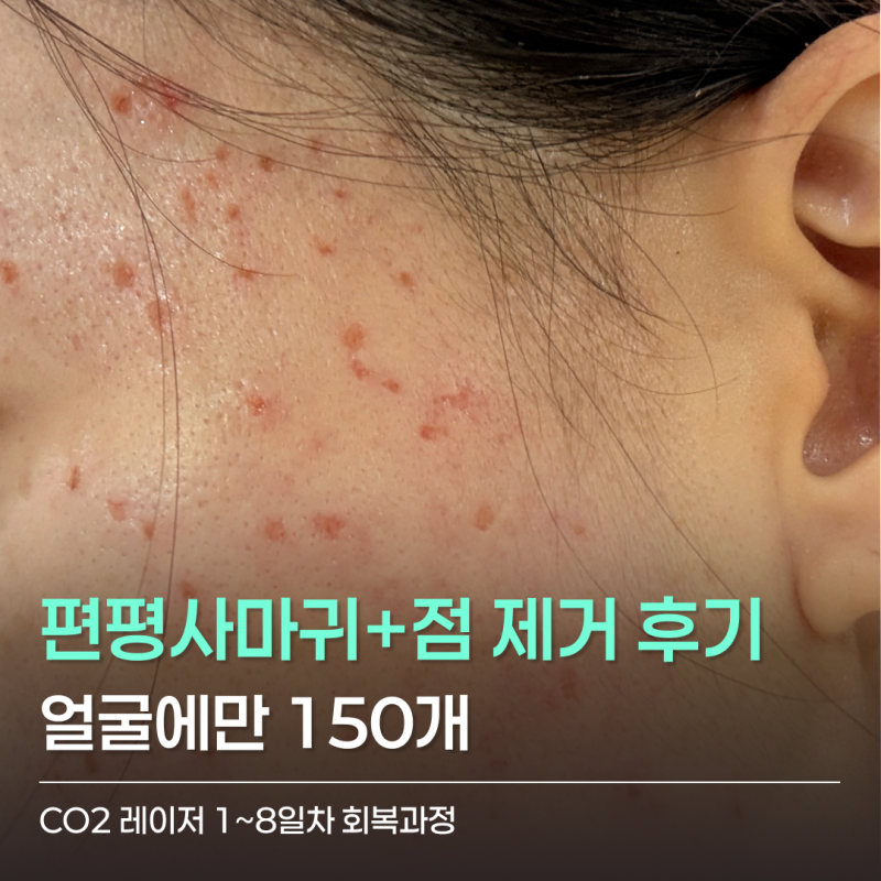 편평사마귀 제거 후기｜얼굴 150개 이상 CO2 레이저 1~8일차 회복과정