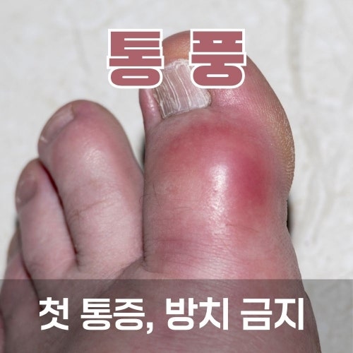 통풍 초기증상부터 단계별 통풍증상까지, 새벽에 아픈 원인 정리