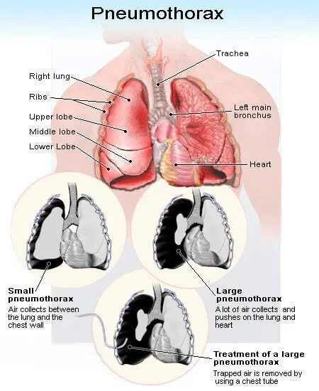 기흉 Pneumothorax 국내외 의료진·의료기관 플랫폼 2026
