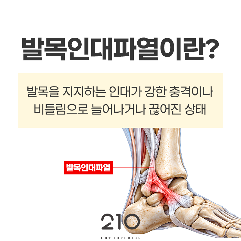 서울 발목인대수술, 꼭 해야 하나요? 수술 기준과 방법