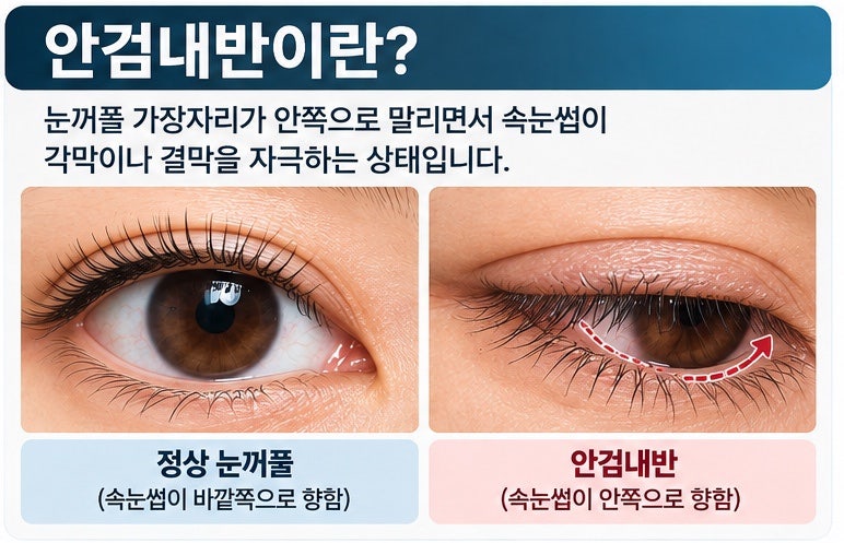 안검내반 증상부터 치료까지｜안검하수와 뭐가 다를까?