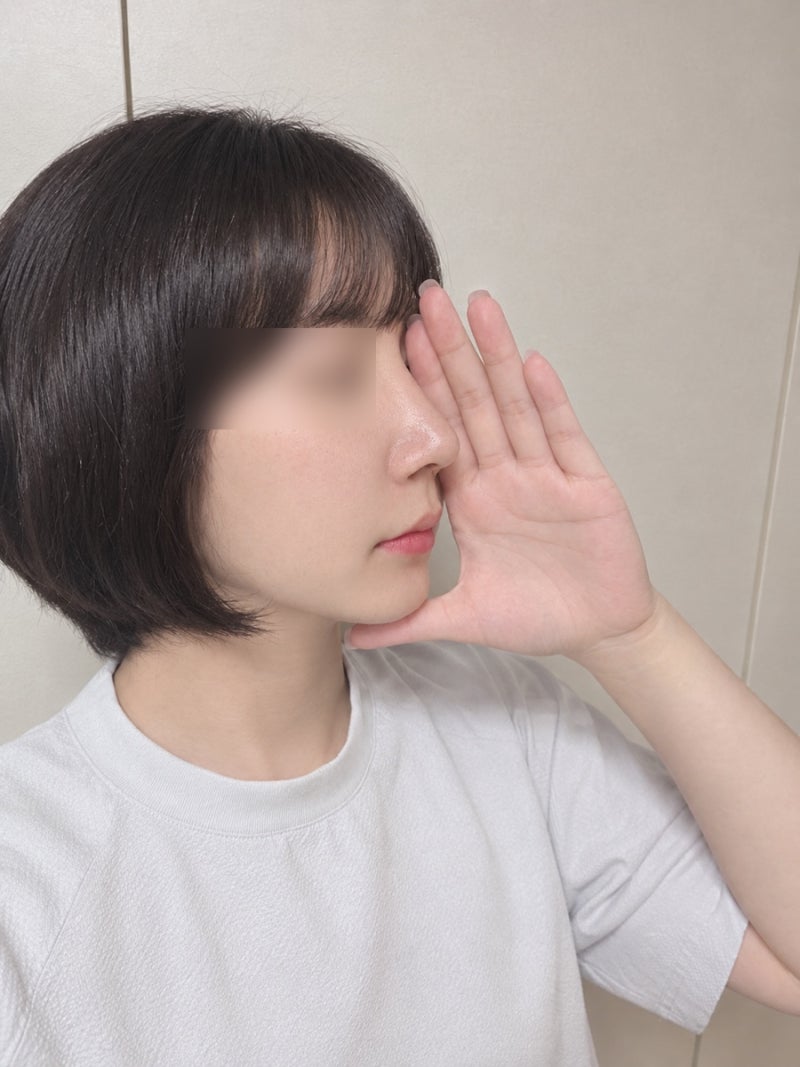 매부리코에 비염까지 있다면? 기능코성형 비포애프터 4주차 회복 일기