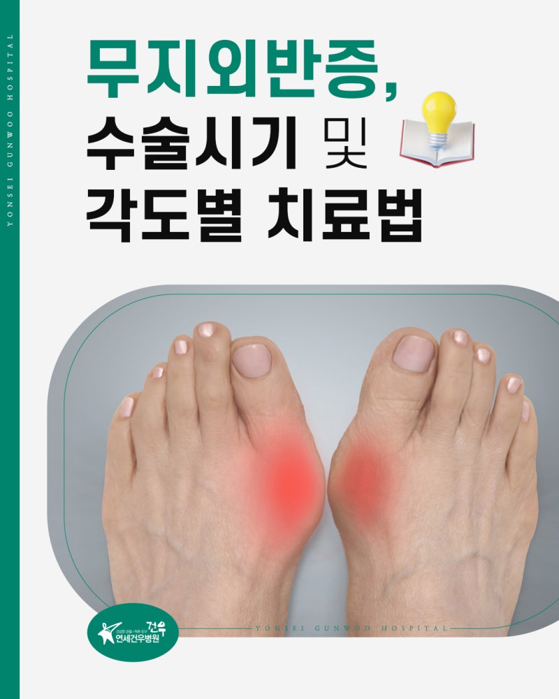 무지외반증 수술 시기 및 각도별 치료법