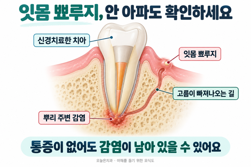신경치료한 치아 잇몸에 뾰루지, 안 아픈데 그냥 둬도 될까요?