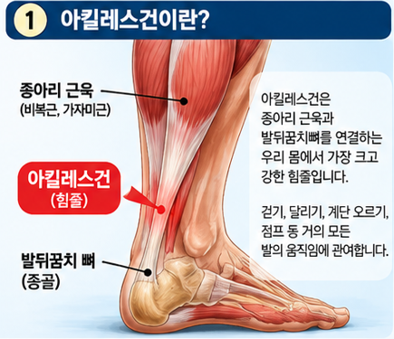 아킬레스건 통증 치료와 재활, 언제부터 걷고 달려도 될까?