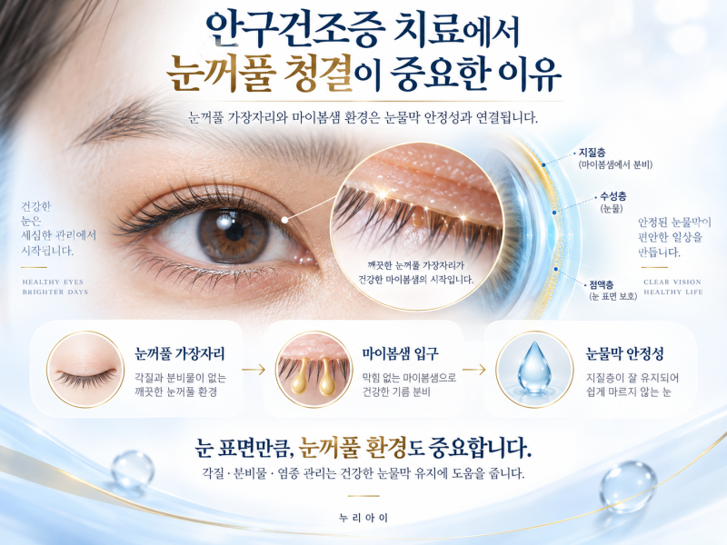 안구건조증 치료에서 눈꺼풀 청결이 중요한 이유