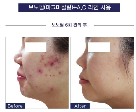 오산 피부관리 라보떼｜피지·각질 고민, 에끌라두 A.C 라인을 소개합니다