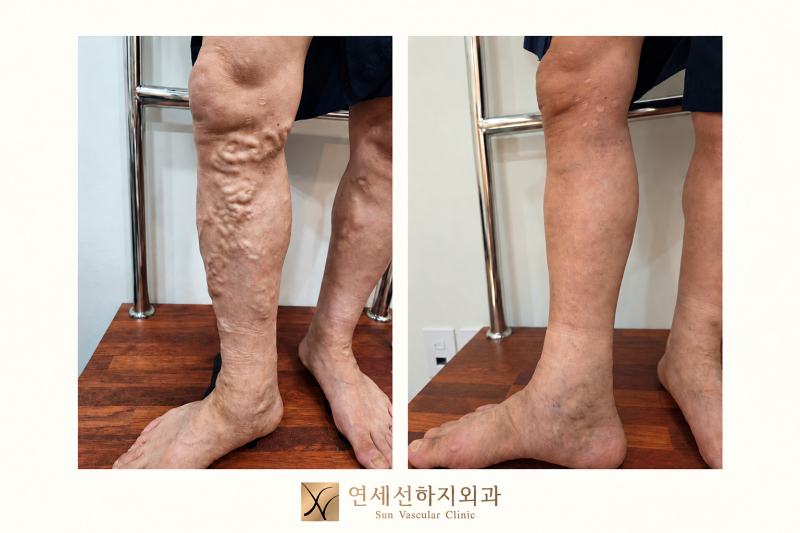 하지정맥류 수술 부작용 걱정된다면 꼭 확인해야 할 1가지