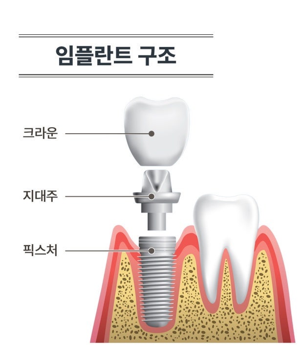 임플란트 수술 후 통증, 참지 말고 미리 줄이세요 | 해운대 임플란트 통증 관리 – 수술 시간 ....