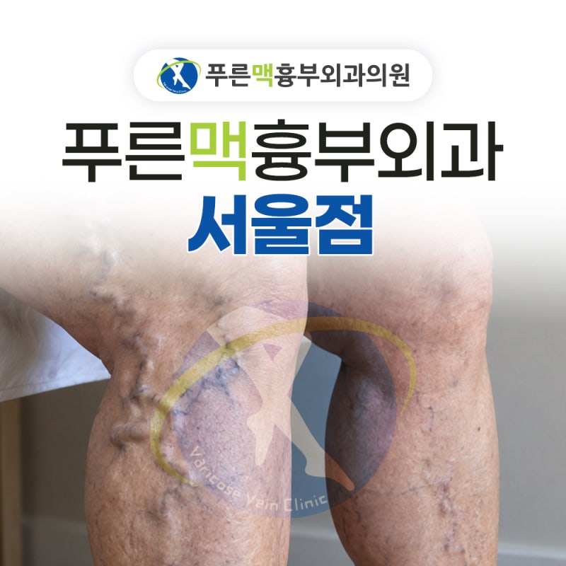 서울하지정맥류 : 다리 부종과 저림, 무시하면 안 되는 응급신호 5가지