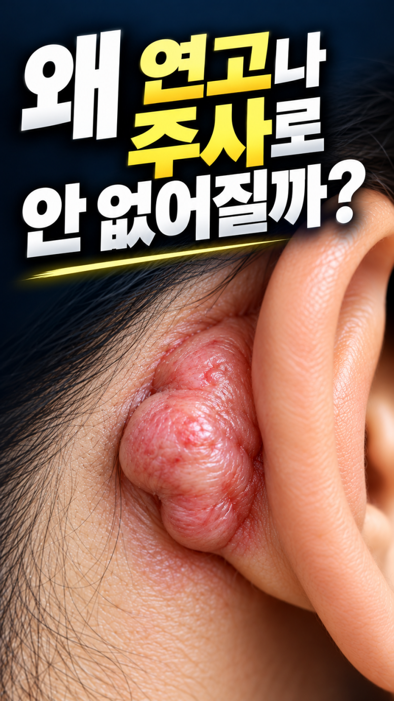 피어싱 몽우리, 연고 바르고 주사 맞아도 왜 안 없어질까? 귀 켈로이드 재발의 진실 (성형외....