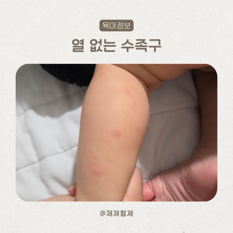 열이 안 났는데 수족구라고요? 일차별 수포 변화와 등원 시기