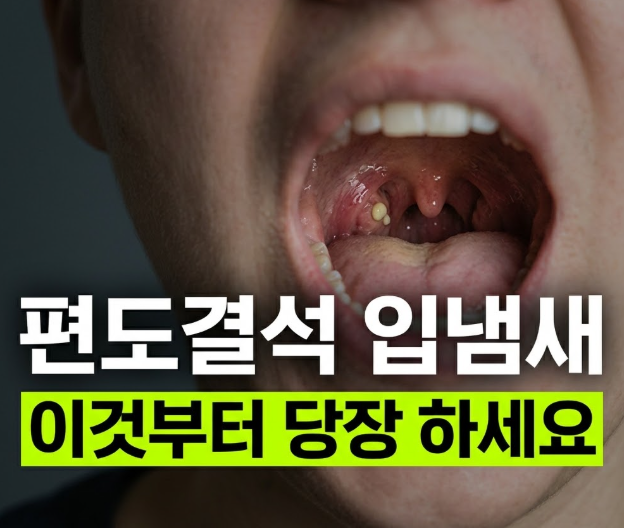 양치해도 안 사라지는 입 냄새…원인은 목 안쪽 '편도 결석'?