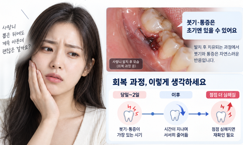 사랑니 발치 후 통증, 며칠 지나 더 아프다면? 드라이소켓?