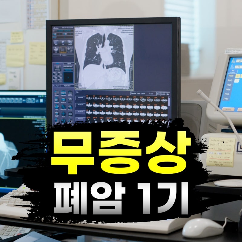 폐암, 아무 증상 없어도 생길 수 있습니다. 건강검진에서 발견된 폐암 1기