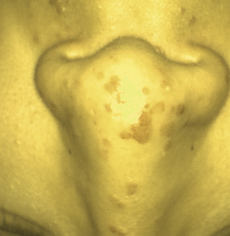 얼굴 편평사마귀 제거 후 번지지 않으려면 HPV 바이러스를 소멸해야