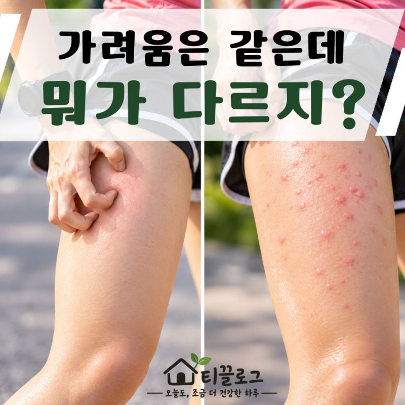 운동할 때 몸이 가렵다면? 러너스이치와 콜린성 두드러기 구별하는 법