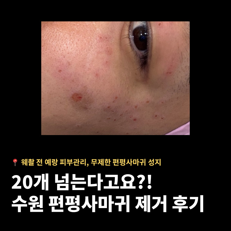 수원 편평사마귀 제거 성지 2곳 비교｜점·비립종·흑자 무제한 가격부터 예약 꿀팁