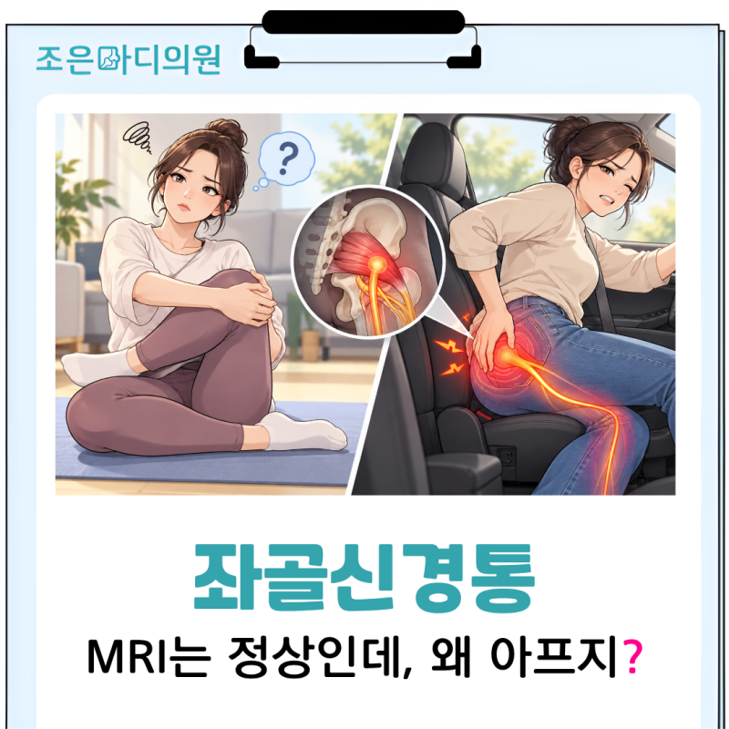 전주 이상근증후군 좌골신경통 다리저림, 이상근 스트레칭 효과가 없으셨나요?