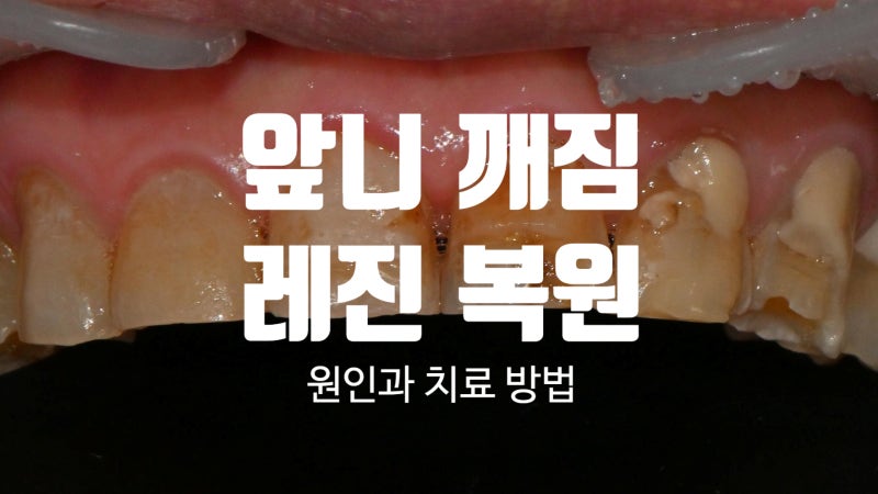 앞니 여러개 깨졌을 때 레진 복원 가능할까?