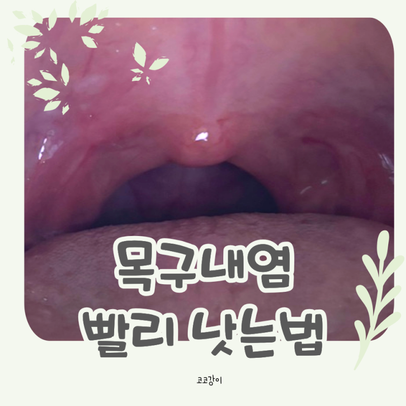 목 구내염 빨리 낫는법 침 삼킬때 목안이 많이 아팠던 2주간