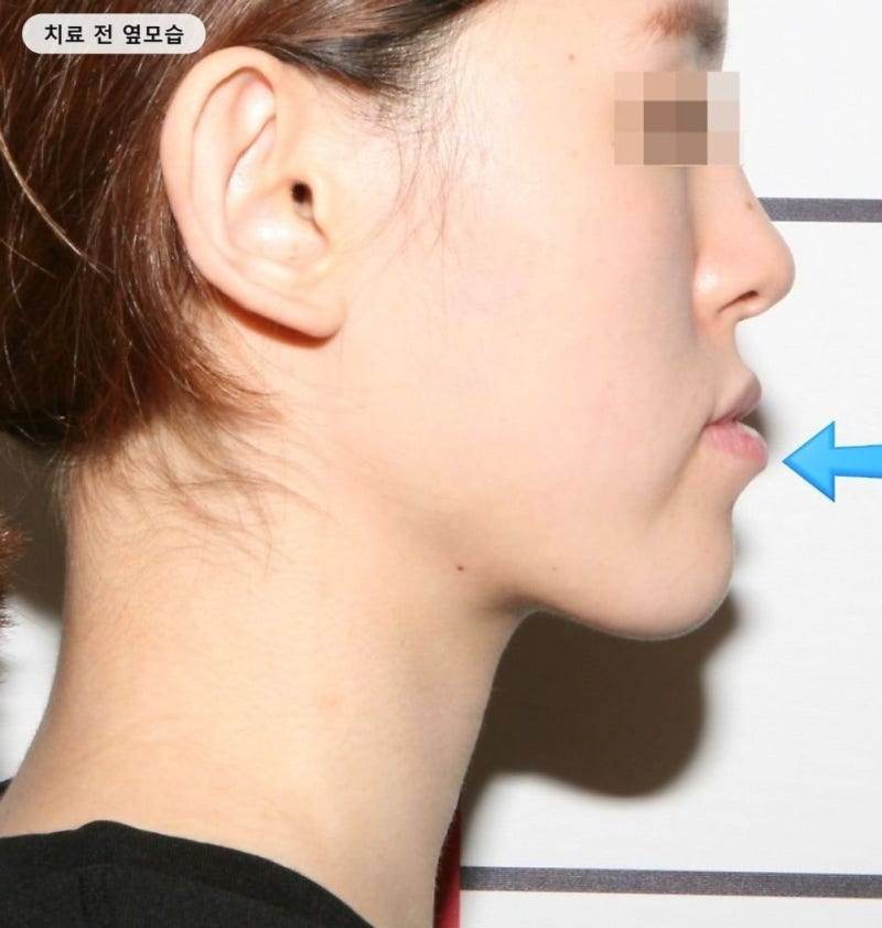 반대교합 교정, 수술 권유받던 주걱턱이 3단계로 바뀐 실제 후기