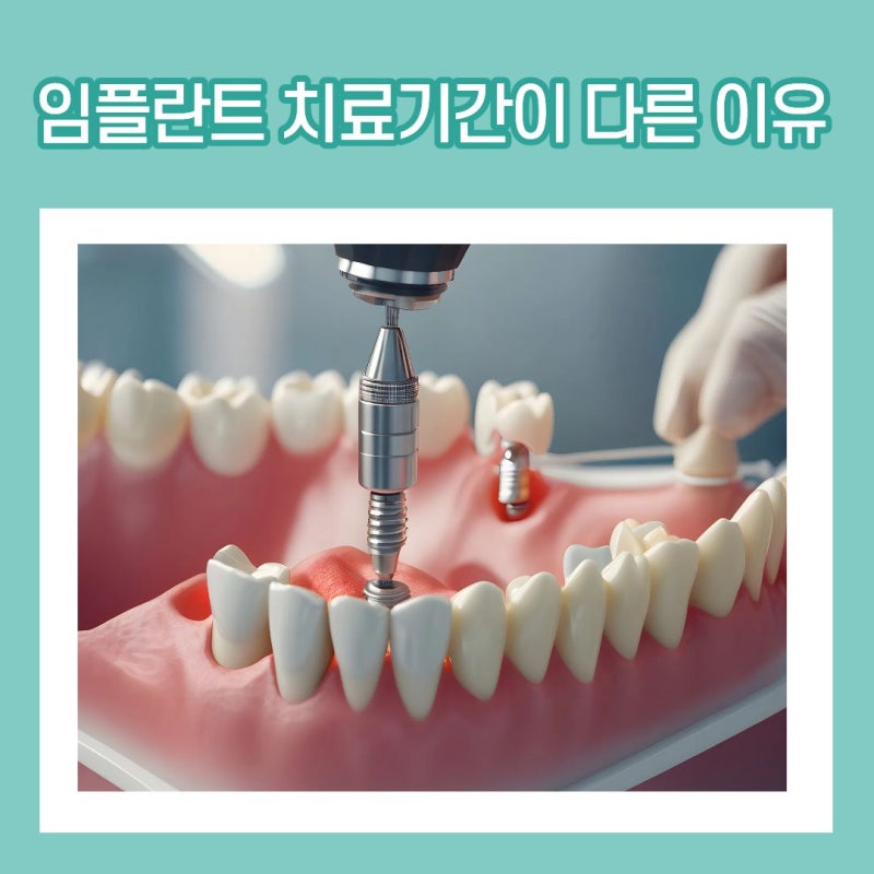 임플란트 치료기간이 다른 이유, 내 치료는 왜 더 오래 걸릴까?