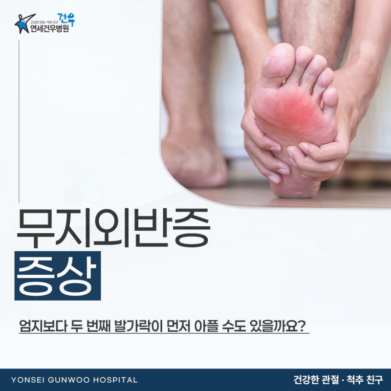 무지외반증 증상 엄지보다 두 번째 발가락이 먼저 아플 수도 있을까요?
