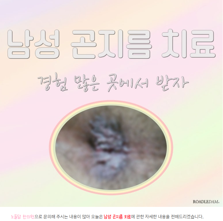 남성 곤지름(콘딜로마) 발병 초기 증상, 환부 치료