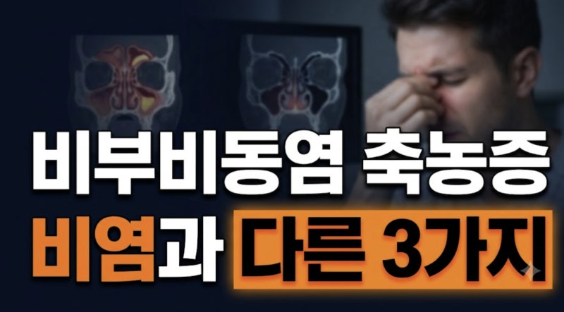 비부비동염 증상과 비염 차이 총정리: 축농증 수술과 코세척 관리법