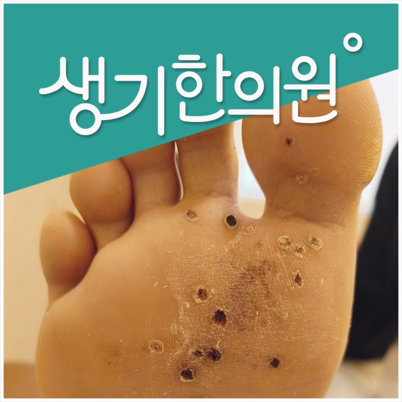 족저사마귀 레이저 수술, 냉동치료, 한방치료 어떤 차이가 있을까?