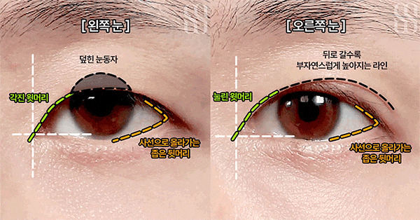 한쪽 쌍꺼풀은 높고 다른 쪽은 풀린 짝눈,두줄따기와 눈매교정은 어떻게 다를까요
