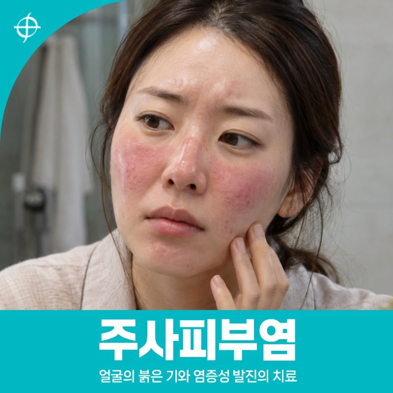 구미주사피부염 | 얼굴의 붉은 기와 염증성 발진의 치료