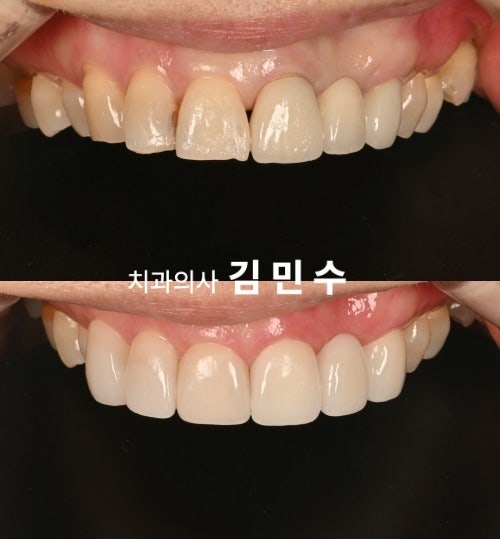 오래된 앞니 크라운, 잇몸 경계가 드러나 보일 때 다시 해야 할까요? 무삭제 라미네이트로 심....