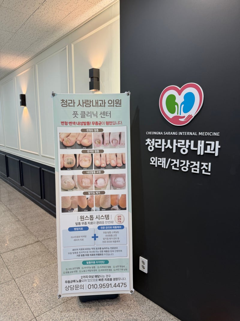 인천 청라 발톱무좀 확실한 정리