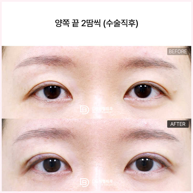 짝눈교정, 한쪽 안검하수가 심하다면 확인할 점