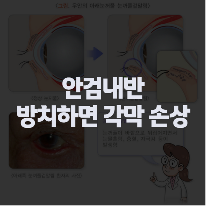 안검내반 증상부터 수술까지, 유아·성인 안검내반 치료 방법 정리