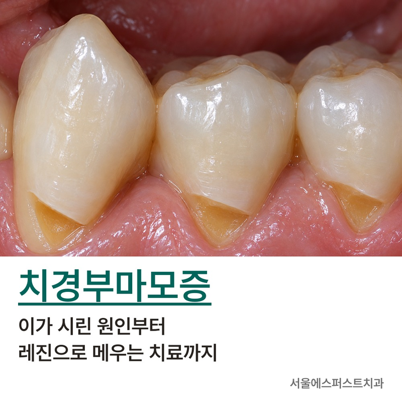 치경부마모증, 이가 시린 원인부터 레진으로 메우는 치료까지
