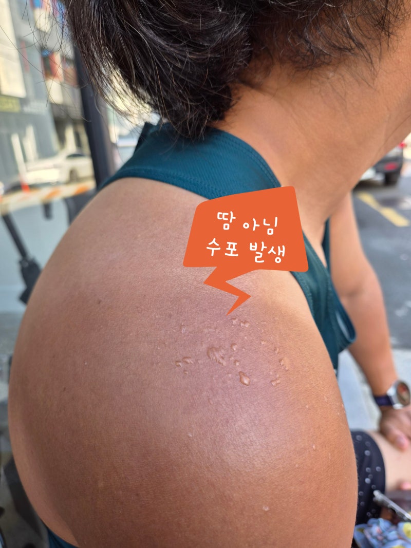 마라톤 선크림 얼굴에만 바르다 피부과 갔다, 오브제 선크림 300ml 6개월 사용 후기