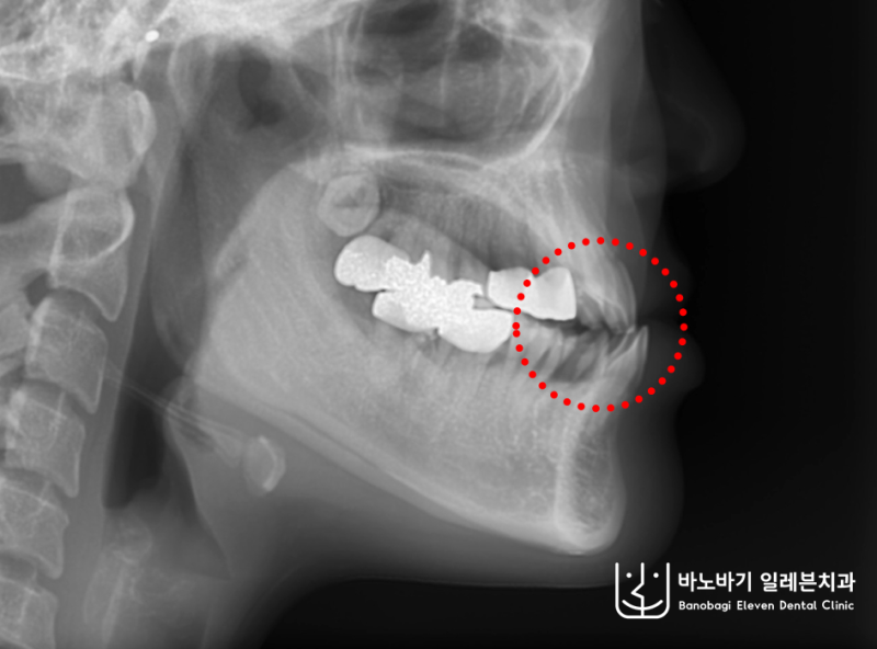 주걱턱 옆모습 교정, 양악수술을 안 해도 된다고요? (비수술 치아교정 전후 비교)