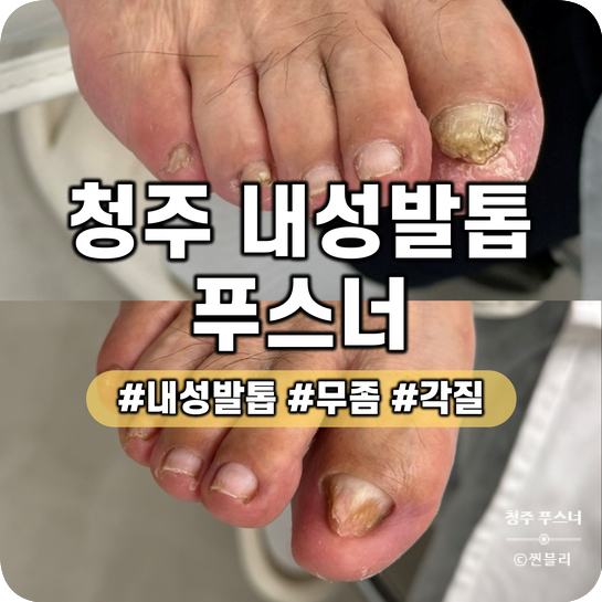 청주 율량동 내성발톱 문제성발 관리 푸스너 발톱스케일링 후기